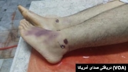 آثار شکنجه بر بدن پیمان گلوانی