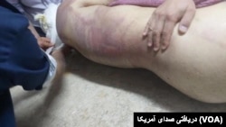 آثار شکنجه بر بدن پیمان گلوانی