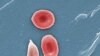 FILE - This 2009 colorized microscope image made available by the Sickle Cell Foundation of Georgia via the Centers for Disease Control and Prevention shows a sickle cell, left, and normal red blood cells of a patient with sickle cell anemia.