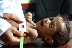 Ahmed Abdo Salem, a 2-year-old Yemeni child displaced by conflict and suffering from malnutrition (weighing only five kilos), is measured at a health clinic in the war-ravaged western Hodeida province,  Yemen, Feb. 15, 2021.