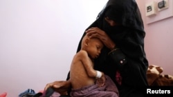FILE - The mother of Radhi Awadh, 2, holds him at a malnutrition treatment ward of al-Sabeen hospital in Sanaa, Yemen, Feb. 13, 2021. 